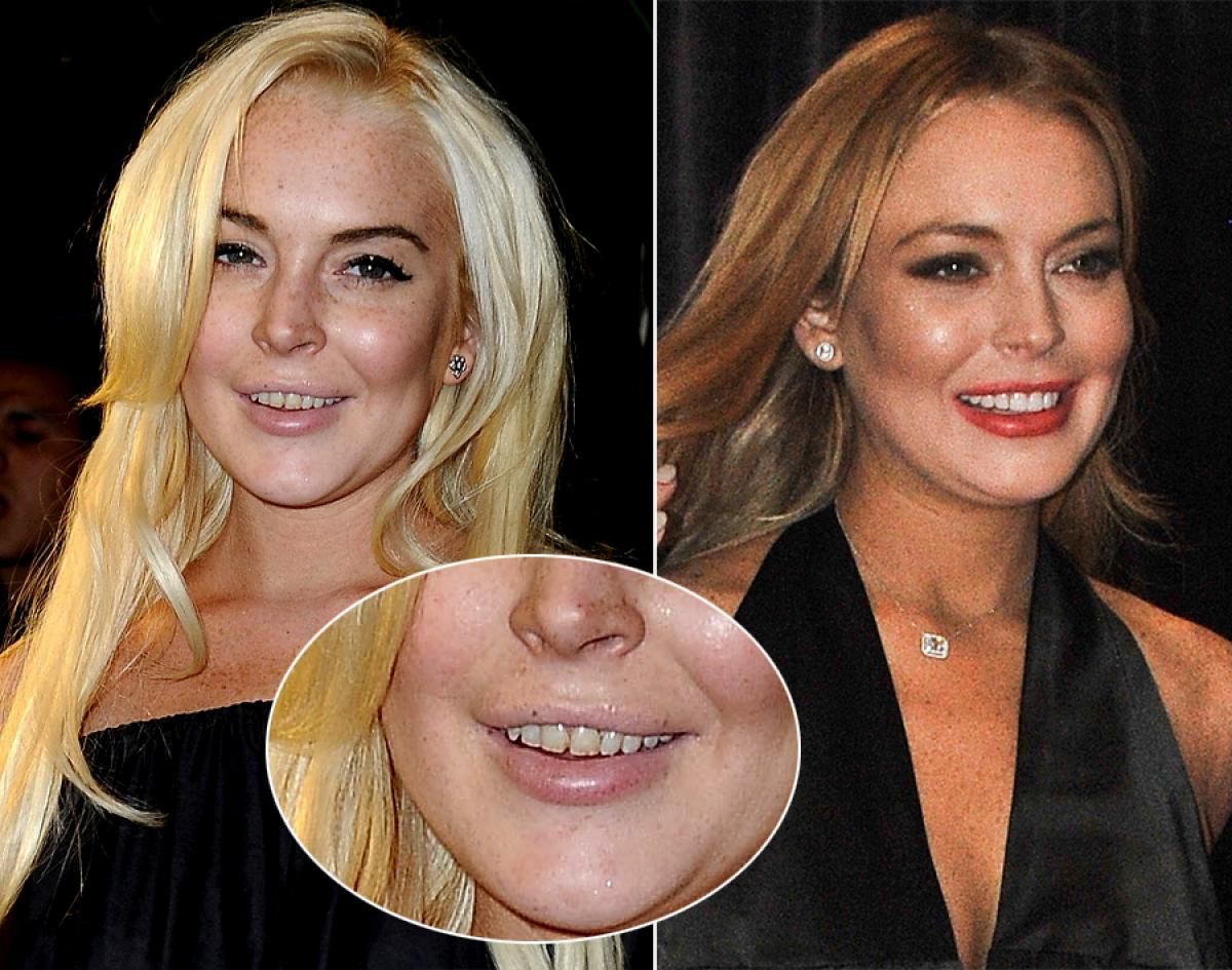 Top 20 de celebridades con mala dentadura Lindsay Lohan